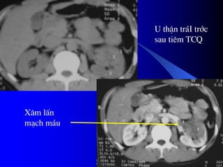 U thËn tr¸I tríc
sau tiªm TCQ
X©m lÊn
m¹ch m¸u
 