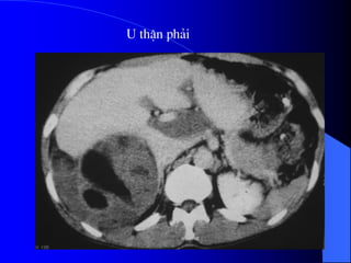 U thËn ph¶i
 