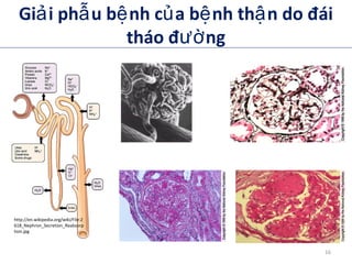 Gi i ph u b nh c a b nh th n do đáiả ẫ ệ ủ ệ ậ
tháo đ ngườ
The kidney. Brenner’s
2003
http://en.wikipedia.org/wiki/File:2
618_Nephron_Secretion_Reabsorp
tion.jpg
16
 