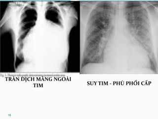 18
TRÀN DỊCH MÀNG NGOÀI
TIM SUY TIM - PHÙ PHỔI CẤP
 