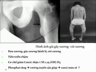 19
Giả gãy xương (mũi tên đỏ)
Hình ảnh giả gãy xương- còi xương
 Đau xương, gãy xương bệnh lý, còi xương
 Tiến triển chậm
 Cơ chế giảm Canxi: thận  SX 1,25 (OH) D3
Phosphat tăng  cường tuyến cận giáp  canxi máu sẽ 
 