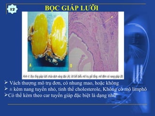 12 BỌC GIÁP LƯỠI
 Vách thượng mô trụ đơn, có nhung mao, hoặc không
 ± kèm nang tuyến nhỏ, tinh thể cholesterole, Không có mô limphô
Có thể kèm theo car tuyến giáp đặc biệt là dạng nhú
 