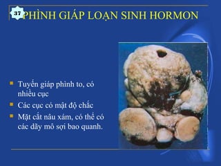 PHÌNH GIÁP LOẠN SINH HORMON
 Tuyến giáp phình to, có
nhiều cục
 Các cục có mật độ chắc
 Mặt cắt nâu xám, có thể có
các dãy mô sợi bao quanh.
37
 