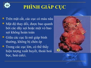PHÌNH GIÁP CỤC
 Trên mặt cắt, các cục có màu nâu
 Mật độ thay đổi, được bao quanh
bởi các dãy sợi hoặc một vỏ bao
sợi không hoàn toàn
 Giữa các cục là mô giáp bình
thường, không bị chèn ép
 Trong các cục lớn, có thể thấy
hiện tượng xuất huyết, thoái hoá
bọc, hoá calci.
53
 