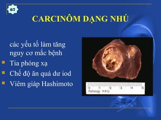 CARCINÔM DẠNG NHÚ
67
các yếu tố làm tăng
nguy cơ mắc bệnh
 Tia phóng xạ
 Chế độ ăn quá dư iod
 Viêm giáp Hashimoto
 