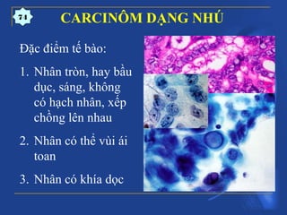 Đặc điểm tế bào:
1. Nhân tròn, hay bầu
dục, sáng, không
có hạch nhân, xếp
chồng lên nhau
2. Nhân có thể vùi ái
toan
3. Nhân có khía dọc
CARCINÔM DẠNG NHÚ74
 