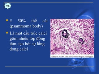  # 50% thể cát
(psammoma body)
 Là một cấu trúc calci
gồm nhiều lớp đồng
tâm, tạo bởi sự lắng
đọng calci
76
 