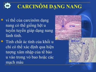 CARCINÔM DẠNG NANG
 vi thể của carcinôm dạng
nang có thể giống hệt u
tuyến tuyến giáp dạng nang
lành tính.
 Tính chất ác tính của khối u
chỉ có thể xác định qua hiện
tượng xâm nhập của tế bào
u vào trong vỏ bao hoặc các
mạch máu
80
 