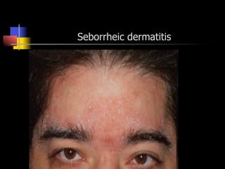 Seborrheic dermatitis
 