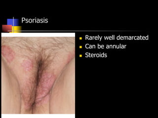 Psoriasis
n  Rarely well demarcated
n  Can be annular
n  Steroids
 