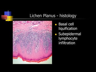 Lichen Planus - histology
n  Basal cell
liquification
n  Subepidermal
lymphocyte
infiltration
 