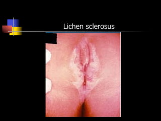 Lichen sclerosus
 
