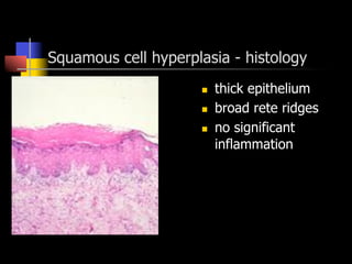 Squamous cell hyperplasia - histology
n  thick epithelium
n  broad rete ridges
n  no significant
inflammation
 