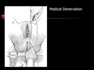 Medical Denervation
 