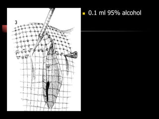 n  0.1 ml 95% alcohol
 