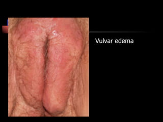 Vulvar edema
 