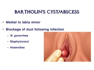 Bartholin’s Cyst/AbscessBartholin’s Cyst/Abscess
• Medial to labia minor
• Blockage of duct following infection
– N. gonorrhea
– Staphylococci
– Anaerobes
 