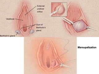 MarsupalizationMarsupalization
 