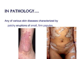 In pathology….In pathology….
Any of various skin diseases characterized by
patchy eruptions of small, firm papules.
 