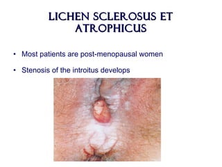 Lichen Sclerosus etLichen Sclerosus et
AtrophicusAtrophicus
• Most patients are post-menopausal women
• Stenosis of the introitus develops
 