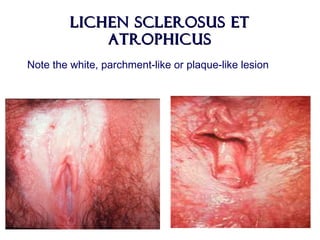 Lichen Sclerosus etLichen Sclerosus et
AtrophicusAtrophicus
Note the white, parchment-like or plaque-like lesion
 