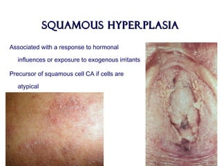 Squamous HyperplasiaSquamous Hyperplasia
Associated with a response to hormonal
influences or exposure to exogenous irritants
Precursor of squamous cell CA if cells are
atypical
 