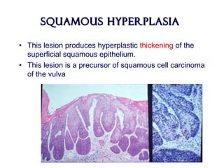 Squamous HyperplasiaSquamous Hyperplasia
• This lesion produces hyperplastic thickening of the
superficial squamous epithelium.
• This lesion is a precursor of squamous cell carcinoma
of the vulva
 