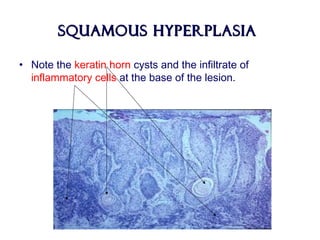 Squamous HyperplasiaSquamous Hyperplasia
• Note the keratin horn cysts and the infiltrate of
inflammatory cells at the base of the lesion.
 