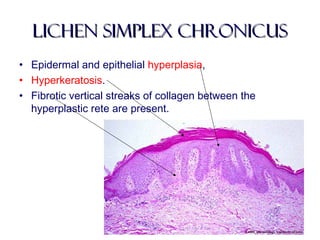 lichen simplex chronicuslichen simplex chronicus
• Epidermal and epithelial hyperplasia,
• Hyperkeratosis.
• Fibrotic vertical streaks of collagen between the
hyperplastic rete are present.
 