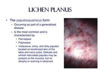 Lichen planusLichen planus
• The papulosquamous form:
– Occurring as part of a generalized
disease
– Is the most common and is
characterized by:
• Flat-topped
• Polyhedral,
• Violaceous, shiny, and itchy papules
located on keratinized skin of the
labia and mons pubis. Delicate and
whitish reticulated papules may be
present on the mucosa, but no
atrophy or scarring is observed.
 