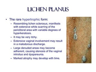 Lichen planusLichen planus
• The rare hypertrophic form:
– Resembling lichen sclerosus, manifests
with extensive white scarring of the
periclitoral area with variable degrees of
hyperkeratosis.
– It may be very itchy.
– Extensive vaginal involvement may result
in a malodorous discharge.
– Large denuded areas may become
adherent, causing stenosis of the vaginal
introitus and dyspareunia.
– Marked atrophy may develop with time.
 