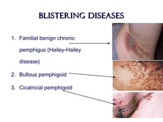 Blistering diseasesBlistering diseases
1. Familial benign chronic
pemphigus (Hailey-Hailey
disease)
2. Bullous pemphigoid
3. Cicatricial pemphigoid
 