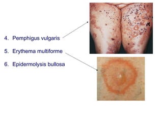 4. Pemphigus vulgaris
5. Erythema multiforme
6. Epidermolysis bullosa
 