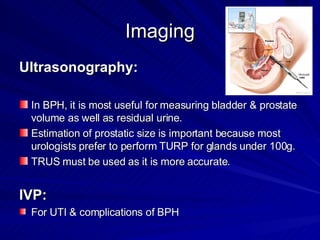 Imaging <ul><li>Ultrasonography: </li></ul><ul><li>In BPH, it is most useful for measuring bladder & prostate volume as we...