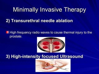 Minimally Invasive Therapy <ul><li>2) Transurethral needle ablation </li></ul><ul><li>High frequency radio waves to cause ...