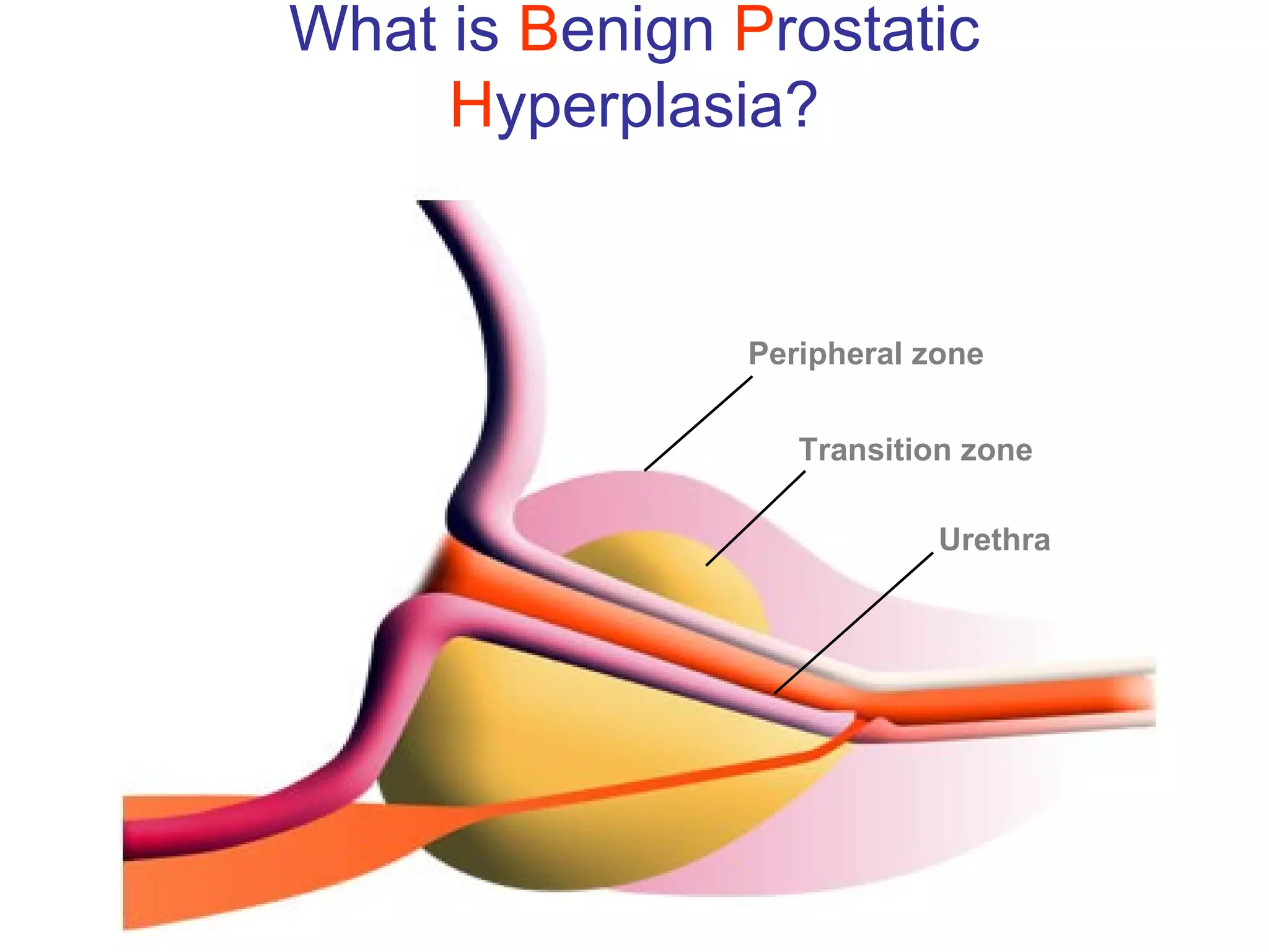 What is Benign Prostatic
     Hyperplasia?


               Peripheral zone


                  Transition zone

                           Urethra
 