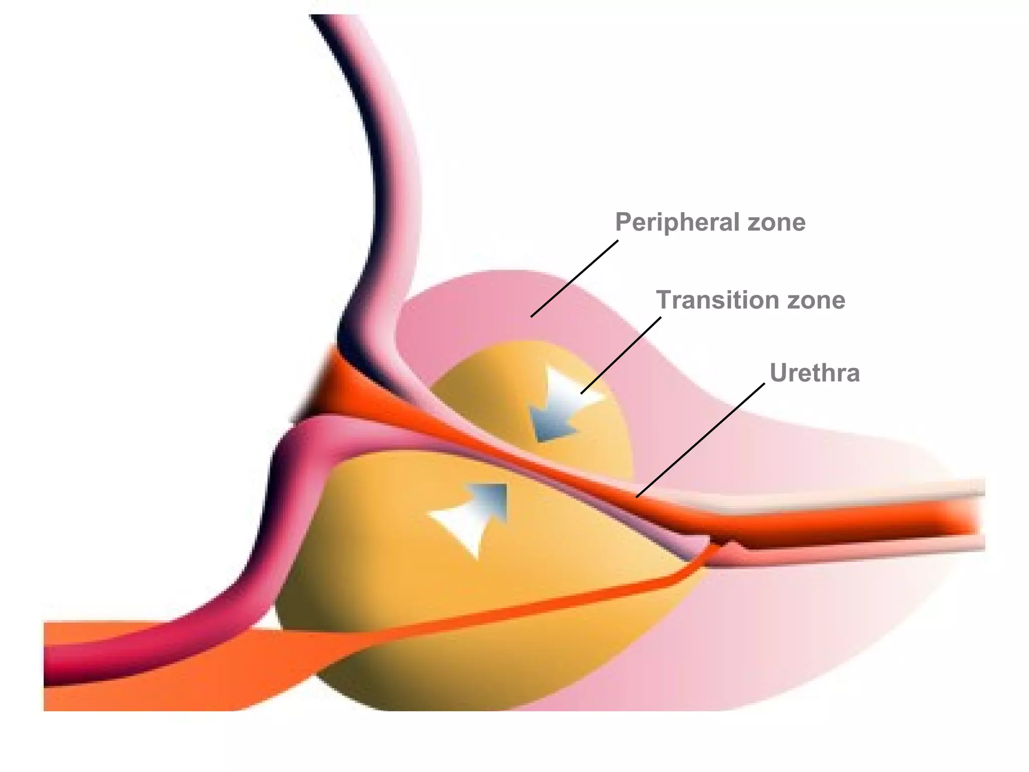 Peripheral zone


   Transition zone

            Urethra
 