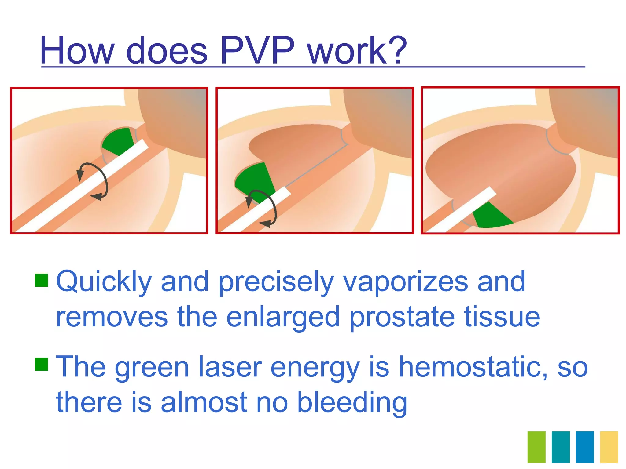 How does PVP work?




 Quickly
       and precisely vaporizes and
 removes the enlarged prostate tissue
 The green laser energy is hemostatic, so
 there is almost no bleeding
 