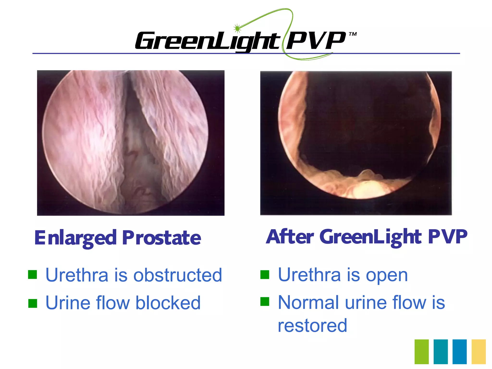 Enlarged Prostate           After GreenLight PVP
   Urethra is obstructed      Urethra is open
   Urine flow blocked         Normal urine flow is
                                restored
 