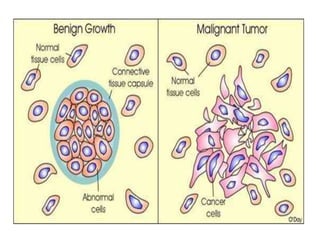 What Is The Difference Between A Benign Tumor And A Malignant Tumor