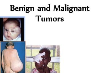 Benign and Malignant
Tumors
 