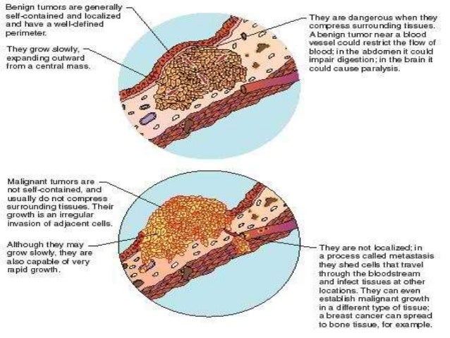 Benign And Malignant Tumor Comparison benign-and-malignant-tumor-comparison