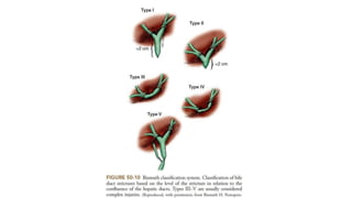 Choledocholithiasis Risk Benign biliary diseases 2.pdfGALL STONES (CHOLELITHIASIS) EMPYEMA OF ...