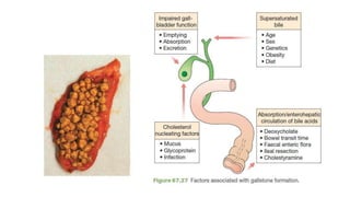 Choledocholithiasis Risk Benign biliary diseases 2.pdfGALL STONES (CHOLELITHIASIS) EMPYEMA OF ...