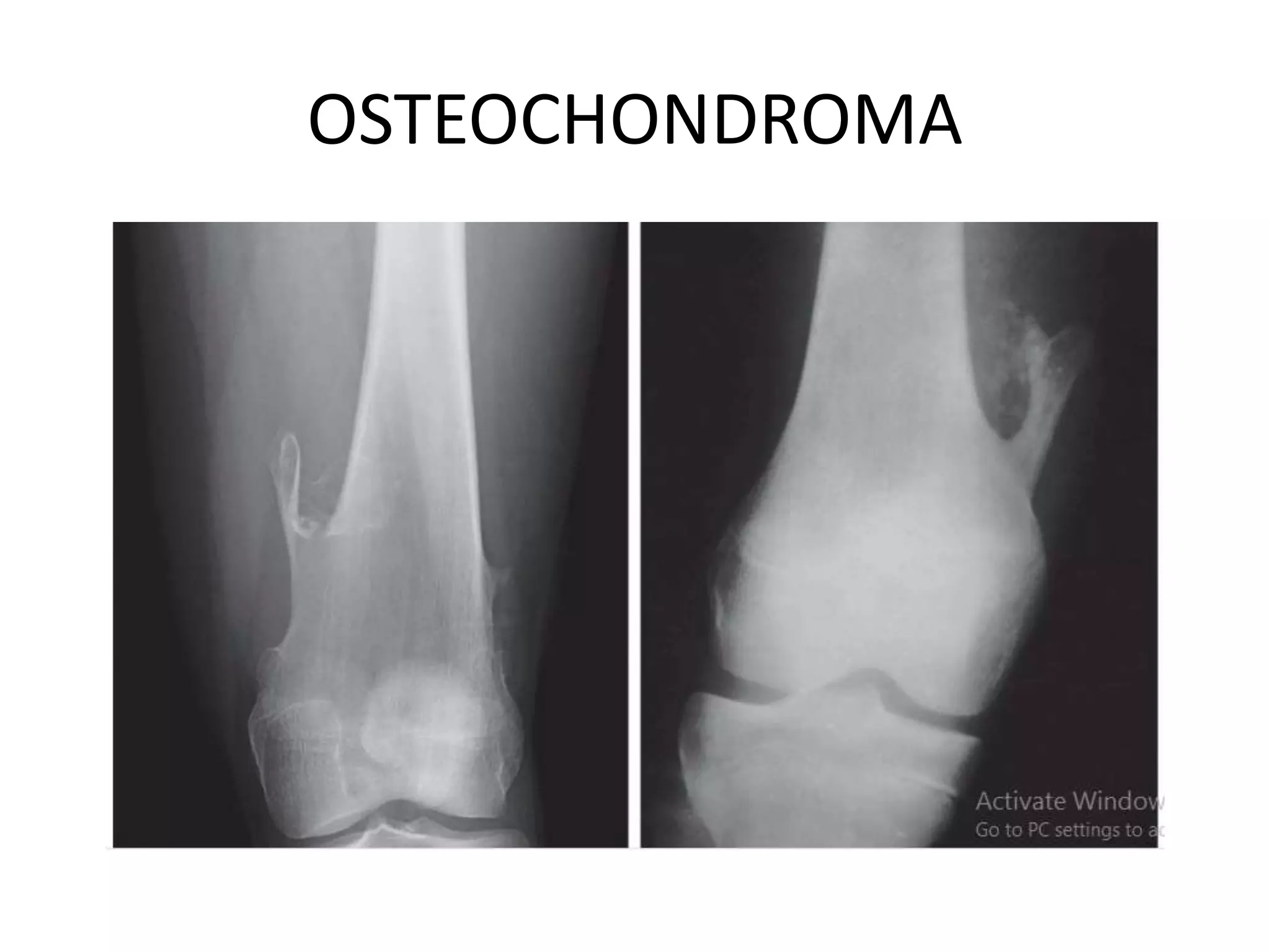 OSTEOCHONDROMA
 