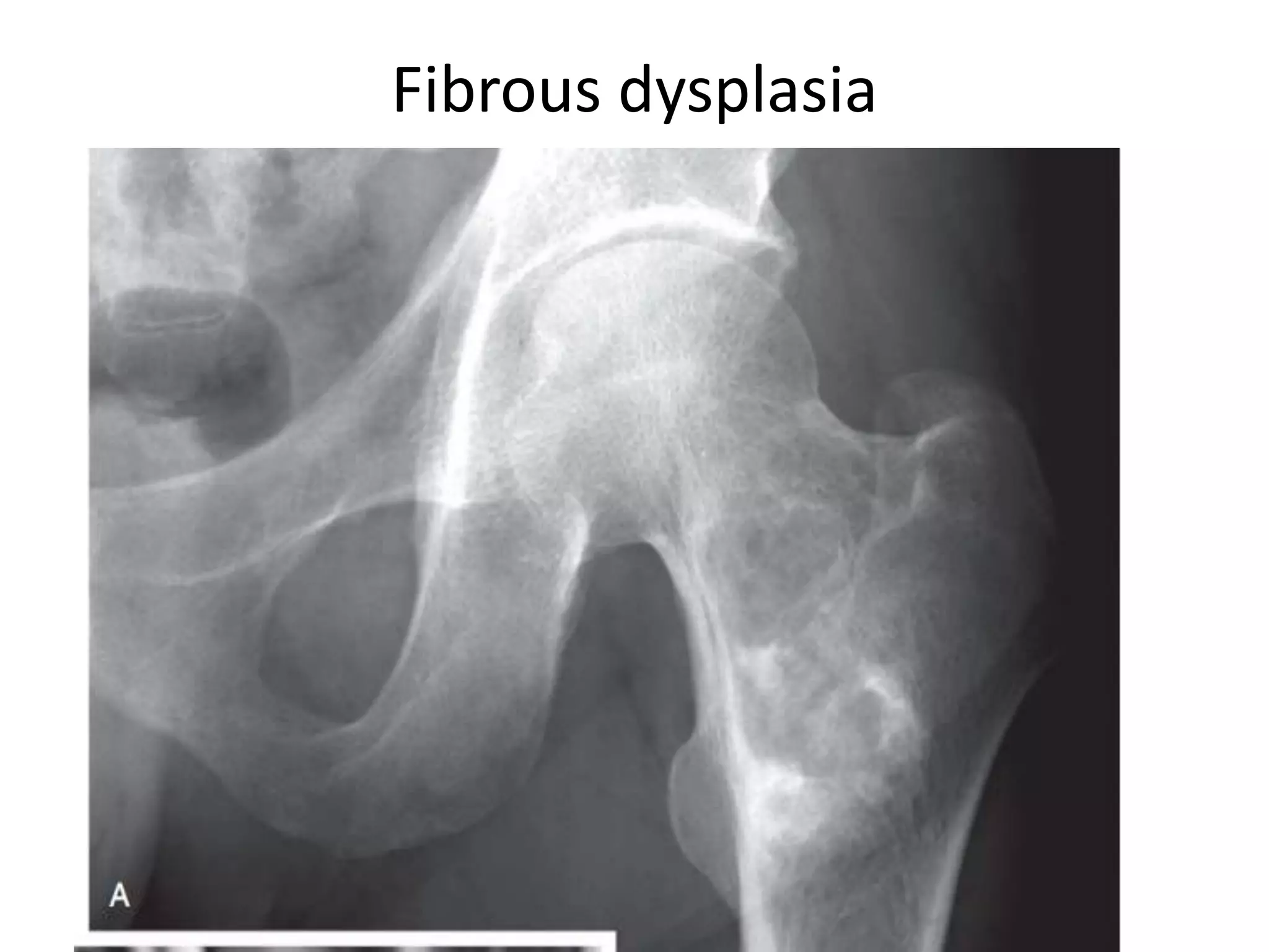 Fibrous dysplasia
 