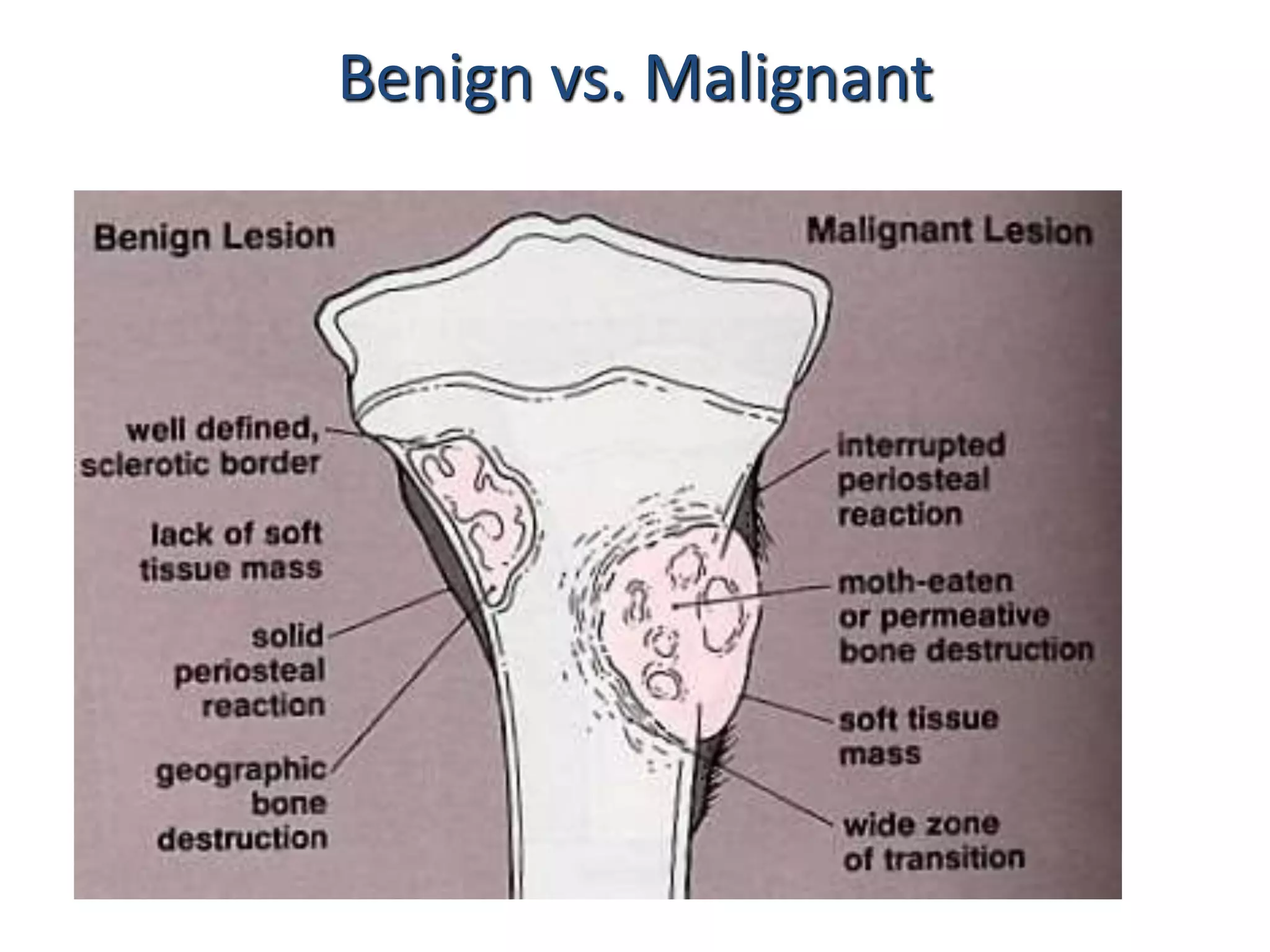 Benign vs. Malignant
 