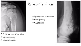 Zone of transition
• A) Narrow zone of transition
• • Long-standing
• • Non-aggressive
• B) Wide zone of transition
• • Fast-growing
• • Aggressive
 