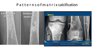 P a t t e r n s o f m a t r i x calcification
 
