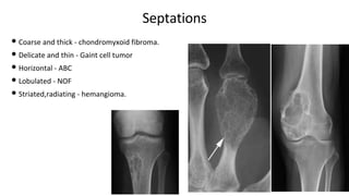 Septations
• Coarse and thick - chondromyxoid fibroma.
• Delicate and thin - Gaint cell tumor
• Horizontal - ABC
• Lobulated - NOF
• Striated,radiating - hemangioma.
 